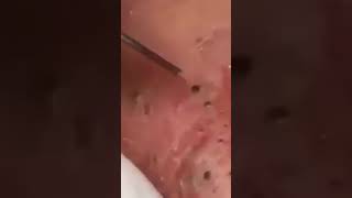 Big Cystic Acne Blackheads Extraction Blackheads & Milia, Whiteheads Removal Pimple Popping#shorts