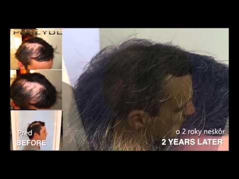 Video: Transplantácia Vlasov - Príčiny Plešatosti, Liečebné Metódy, Chirurgické Zákroky, Recenzie