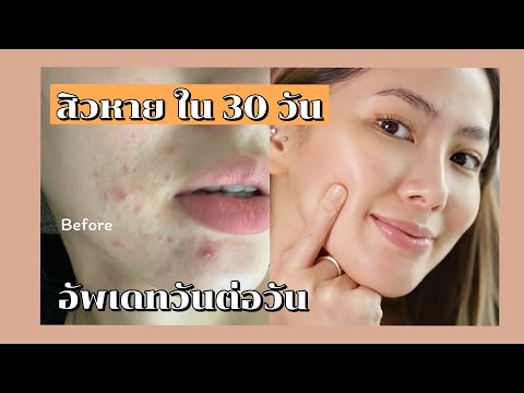 (How to)ผิวแข็งแรง สิวหาย ภายใน30วัน อัดคลิปให้ดูทุกวัน!!!