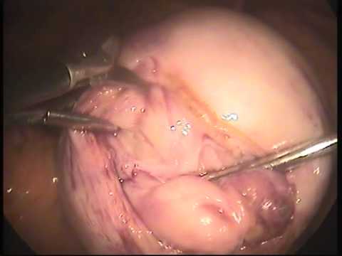 10 cm posterior wall fibroid youtube