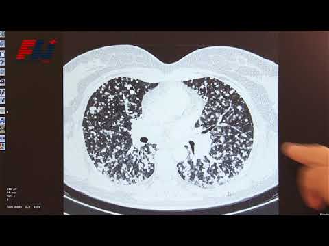 Video: Rakovina Plic (adenokarcinom) U Koček