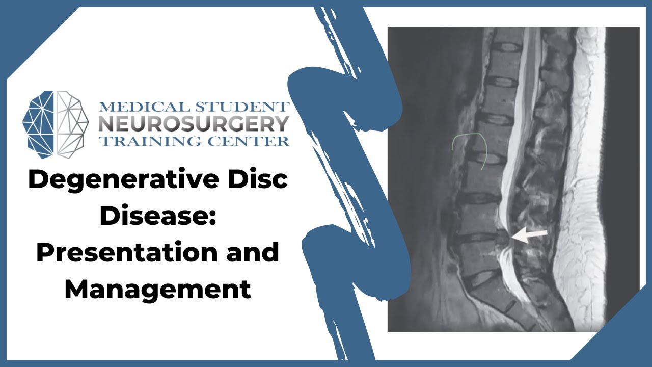 Degenerative Disc Disease: Presentation and Management - YouTube