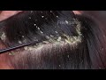 Itchy Dry Scalp!! Dandruff Scratching Satisfying #624