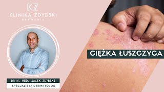 Dermatolog Mówi O Ciężka Łuszczyca A Choroby Serca