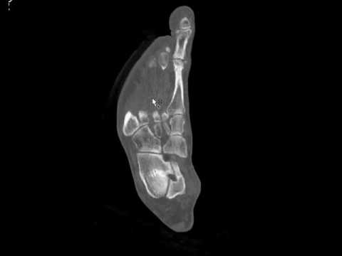 Forefoot CT imaging planes