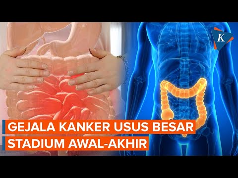 Video: Dapatkah usg mendeteksi kanker usus besar?