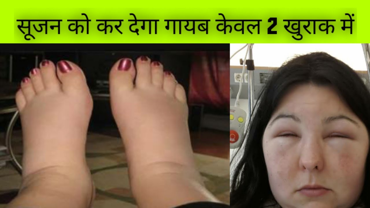 Soojan Kam Karne Ka Tarika , सूजन कम करने का तरीका, swelling treatment