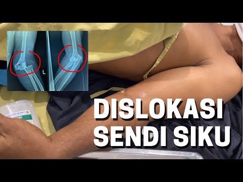 Penanganan Dislokasi Sendi Siku | Elbow Dislocation