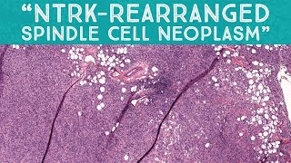 “NTRK-rearranged spindle cell neoplasm” (AIP France 2021 - Case 16) dermpath pathology dermatology screenshot 5