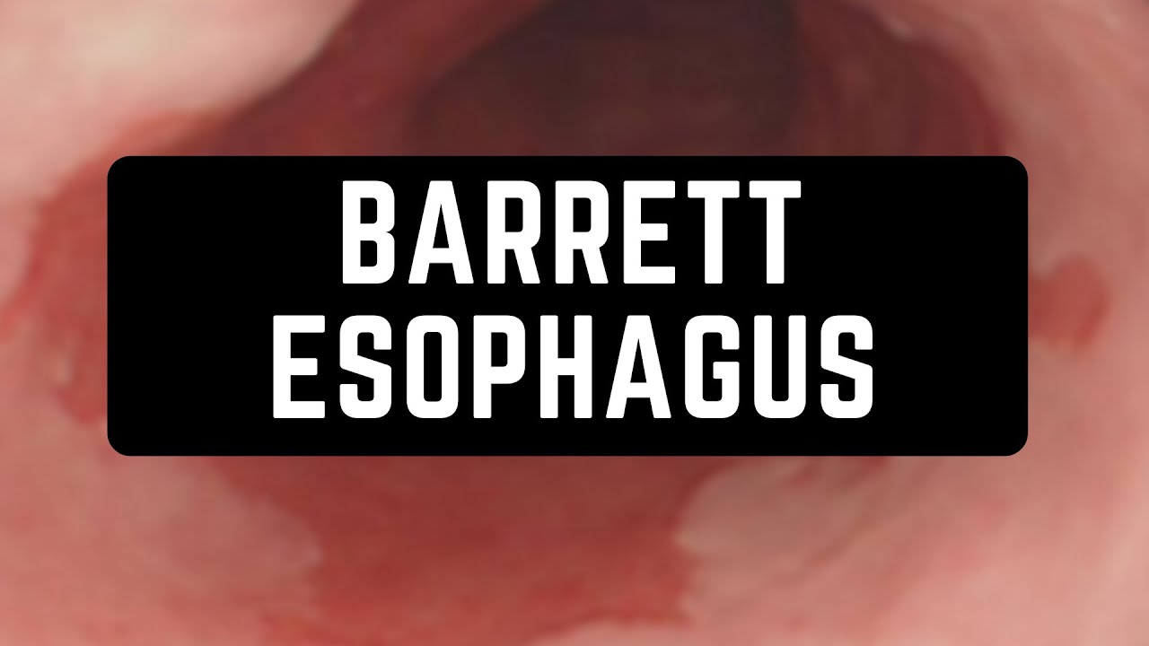 Barrett Esophagus / Gastrointestinal Pathology YouTube