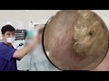 🌀耳掃除 | 超薄型耳垢シュリンク | プロによる耳垢除去と心地よい音
