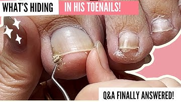 The Ultimate Ingrown Toenail & Pedicure Compilation | Q&A + Fun Stories with Mr. Meticulous! 👣