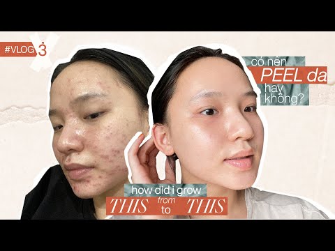 Video Hành trình nâng cấp làn da bằng phương pháp Chemical... - youtube