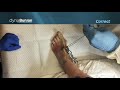 Dynabunion 4d minimal incision lapidus system  cadaveric surgical demo