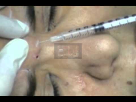 at anti aging 18 Ø§ÙØ¨ÙØªÙØ³ with    Relax Injections Botox ÙØµØ± Ø­ÙÙ egypt