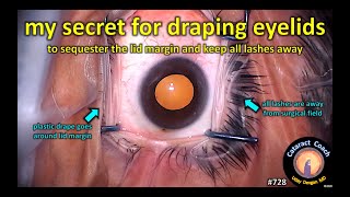 my secret for draping the eyelids in cataract surgery