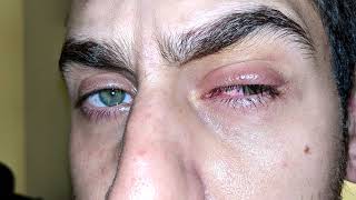 CG E-Begging | Update - Eye Infection