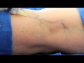 Surface Sclerotherapy at VēNA Clinic