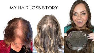 My Hair Loss Story
