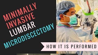 Minimally Invasive Lumbar Microdiscectomy Video - How It's Performed