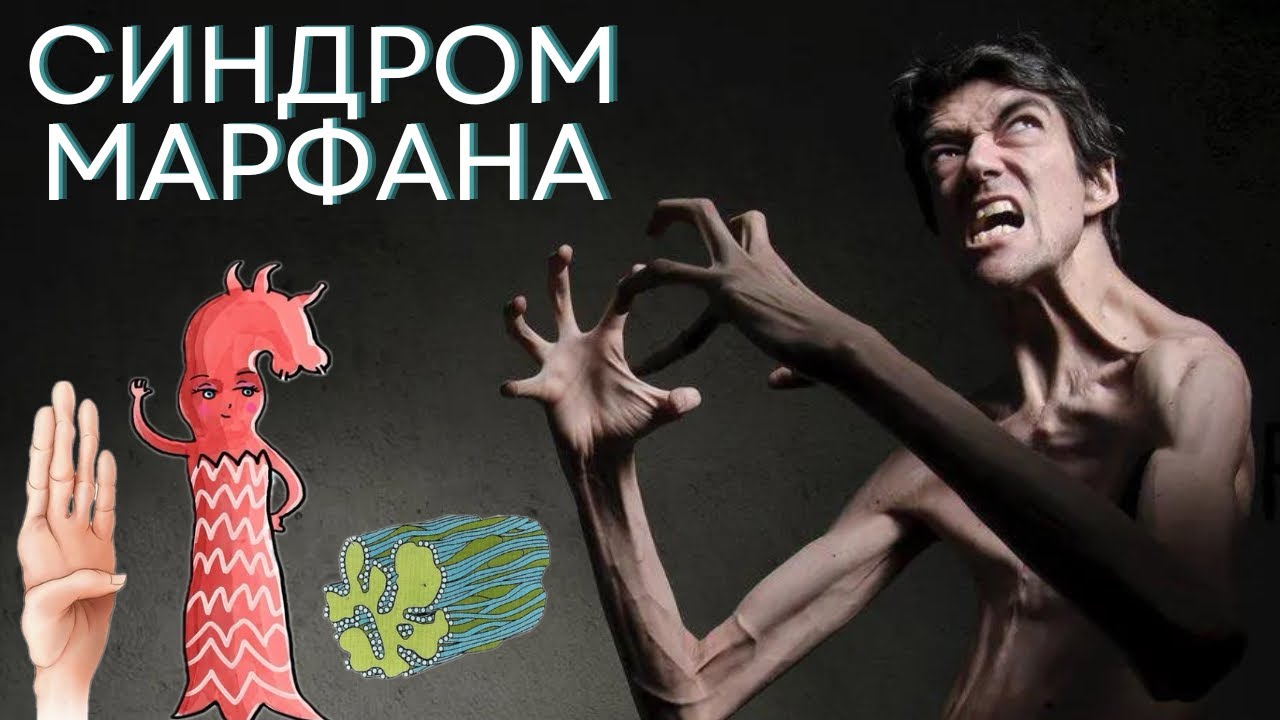 Синдром Марфана | Патогенез, симптомы, диагностика и лечение