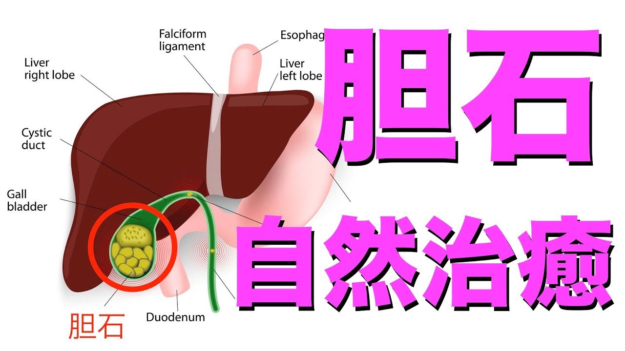 胆石 に 悪い 食べ物