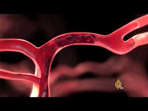 دراسة: أجهزة إزالة الجلطات الدموية أفضل لصحة المريض