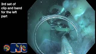 Undersaline clip and band ESD in the ascending colon