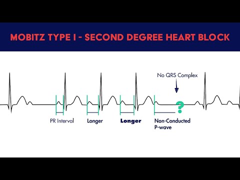 Видео: Муур дахь зүрхний блок (Mobitz Type I)