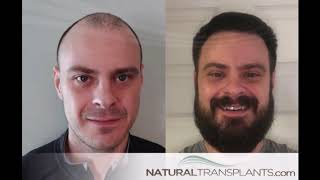 Great Hair Transplant Results | Hair Transplant Results Before After