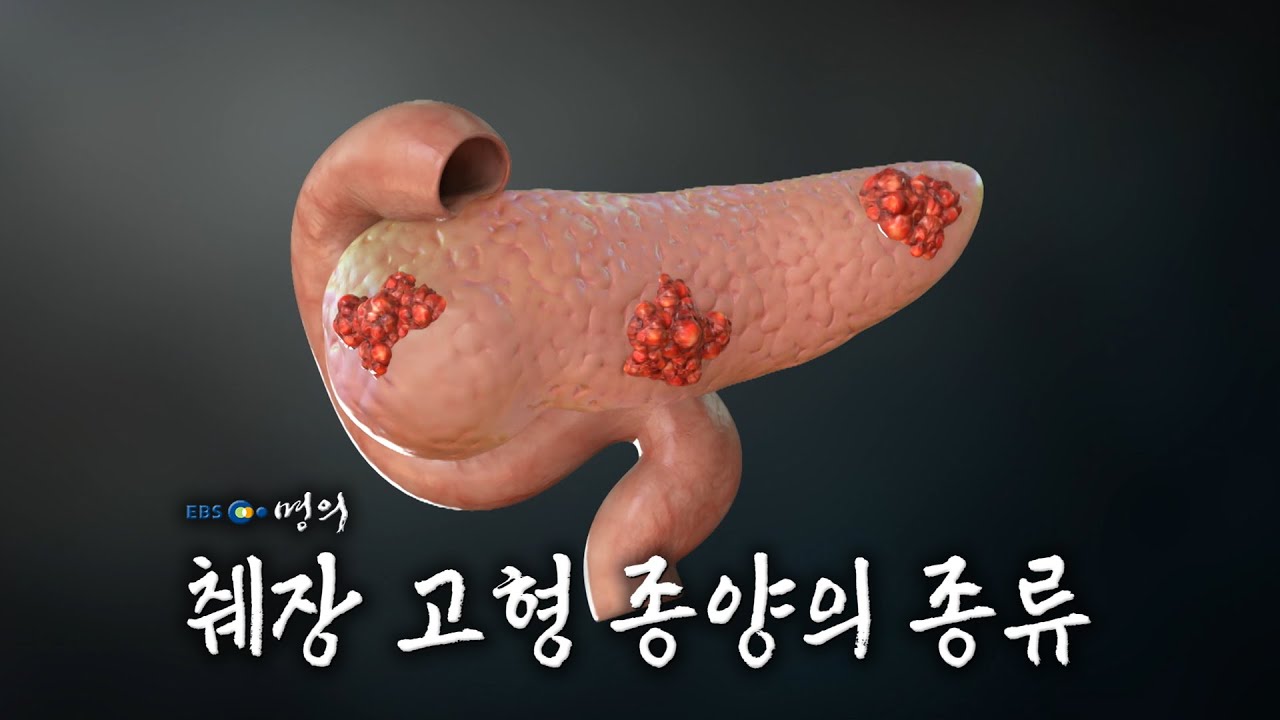 [명의 의학백과📖] 췌장 고형 종양의 종류 - YouTube