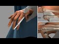 Bioretec ActivaPin™ 5th Metacarpal fracture fixation