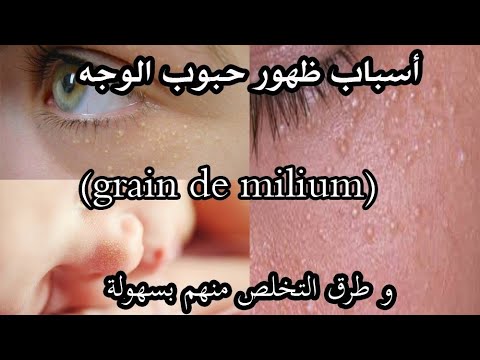 أسباب ظهور حبوب الوجه (grain de milium) وطرق التخلص منهم بسهولة