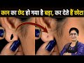 बिना ऑपरेशन, बिना टांके - सिर्फ 10 सेकंड में कान का बड़ा छेद करें छोटा | How To Reduce Ear Hole Size