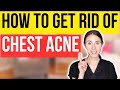 Say Goodbye To Chest Acne With Expert Dermatologist Advice!