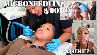 I Got Botox + Microneedling 😅 Was It Worth It?