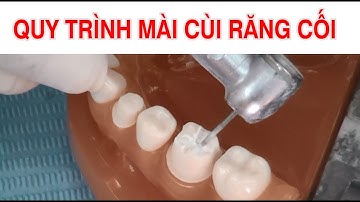 KỸ THUẬT MÀI CÙI RĂNG CỐI (RĂNG HÀM)