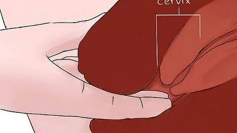 ¿Cómo de abierto tiene que estar el cuello del útero para un barrido?