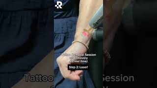 Tattoo removal in real time! Each session at Removery takes anywhere from 30 seconds to 2 minutes!