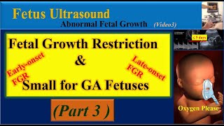 Fetus Ultrasound, Fetal Growth Restriction and Small for Gestational Age Fetuses Part3