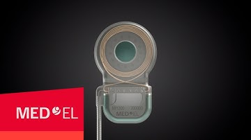 The MED-EL SYNCHRONY Cochlear Implant—MED-EL