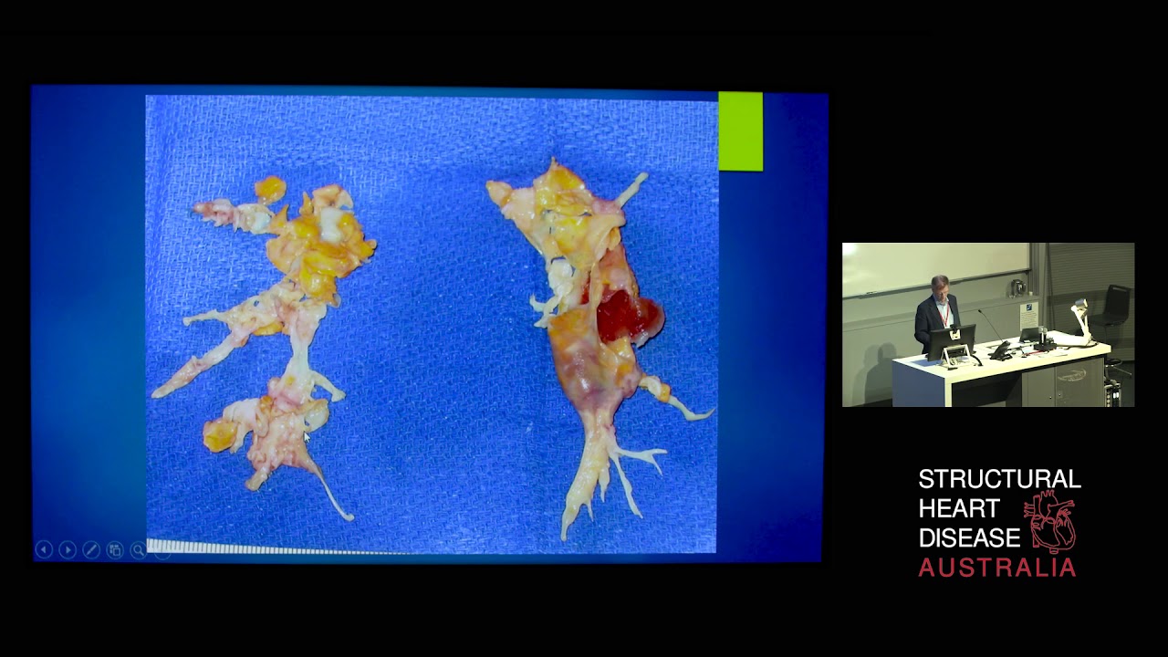 Легочная эндартерэктомия при хронической тромбоэмболической легочной гипертензии — профессор Дэви...