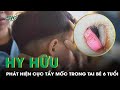 Bệnh Nhi 6 Tuổi Sốt Không Rõ Nguyên Nhân, Đi Khám Phát Hiện Cục Tẩy Mốc Nằm Trong Tai | SKĐS