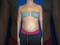 Gynecomastia and Armpit Fat Removed by Board Certified Plastic Surgeon