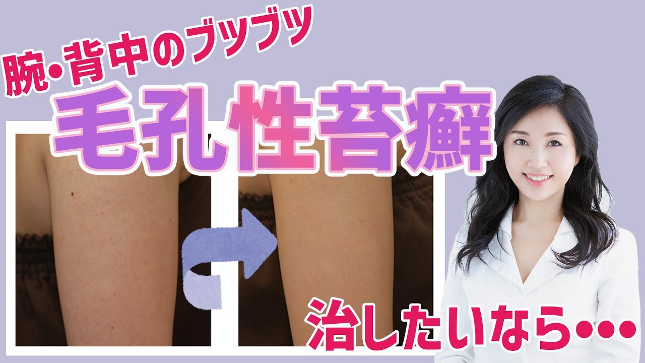 腕や背中のブツブツの正体は 毛孔性苔癬を治したいなら 銀座ケイスキンクリニック Youtube