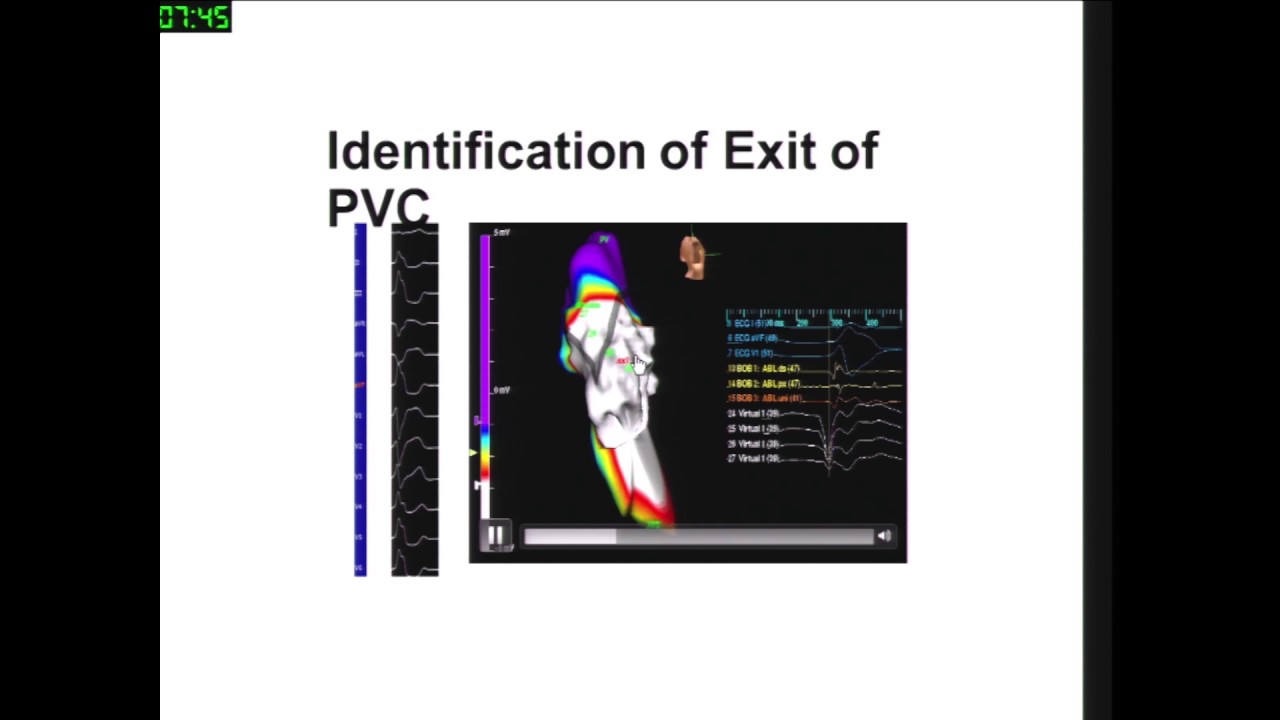 Right Ventricle