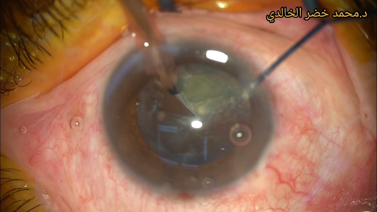 By Phaco... Intumescent Cataract removal with foldable IOL implant