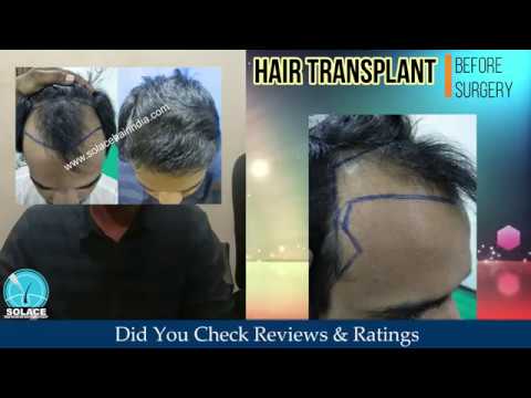 Top Hair Transplant Results In Pune | Best & Natural Hair Transplant  Results | - YouTube