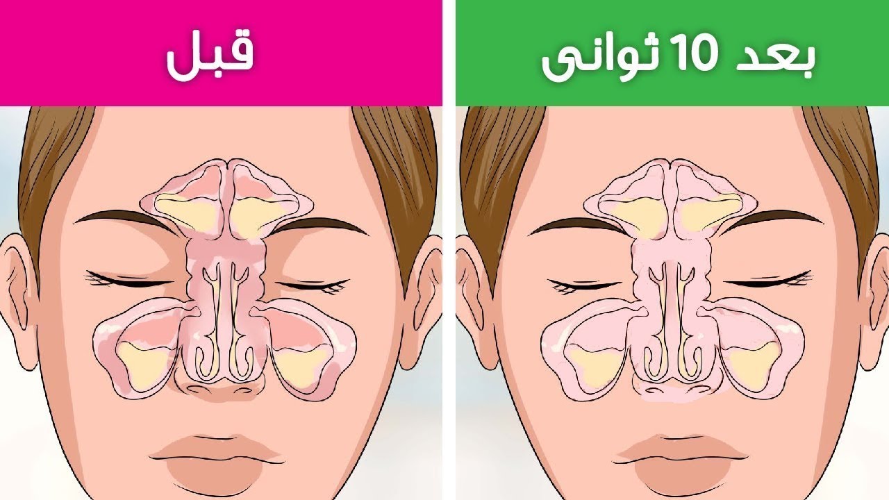 علاج انسداد الانف والتهاب الجيوب الانفية فى 10 ثوانى فقط الجزء الثانى ...
