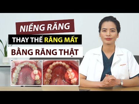 THAY THẾ RĂNG MẤT BẰNG RĂNG THẬT NHỜ CHỈNH NHA – Kéo khít lại khoảng trống mất răng